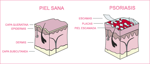 La pigmentación de la piel a atopicheskom la dermatitis
